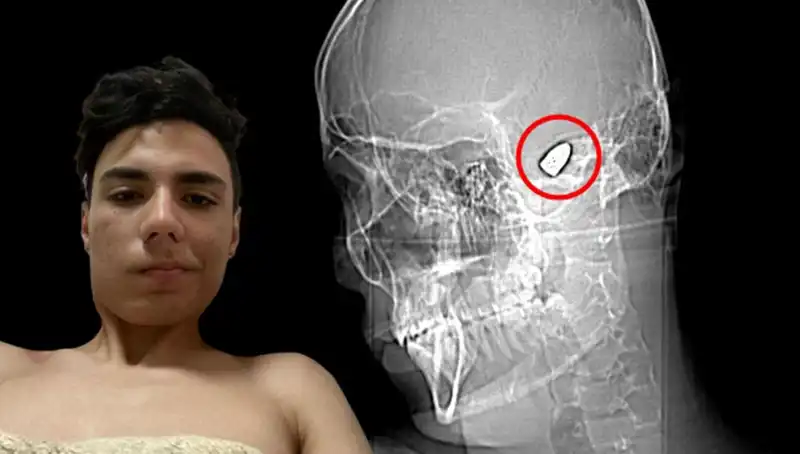 Kafasının İçinde Patlamaya Hazır Bomba Taşıyan Genç Hayatı Nasıl Değişti?